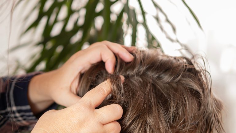 Are Black Specks Lice Droppings or Just Dandruff?