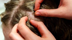 Parent checking a child's hair for head lice with a metal lice comb on a clean surface
