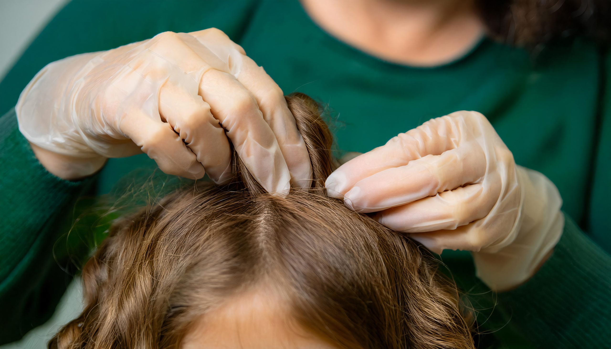 Head lice cleaning on curly textured hair for article about lice and hair types