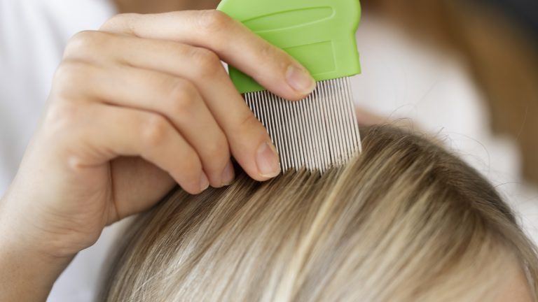 Most Repeat Lice Cases Are One Case That Never Cleared